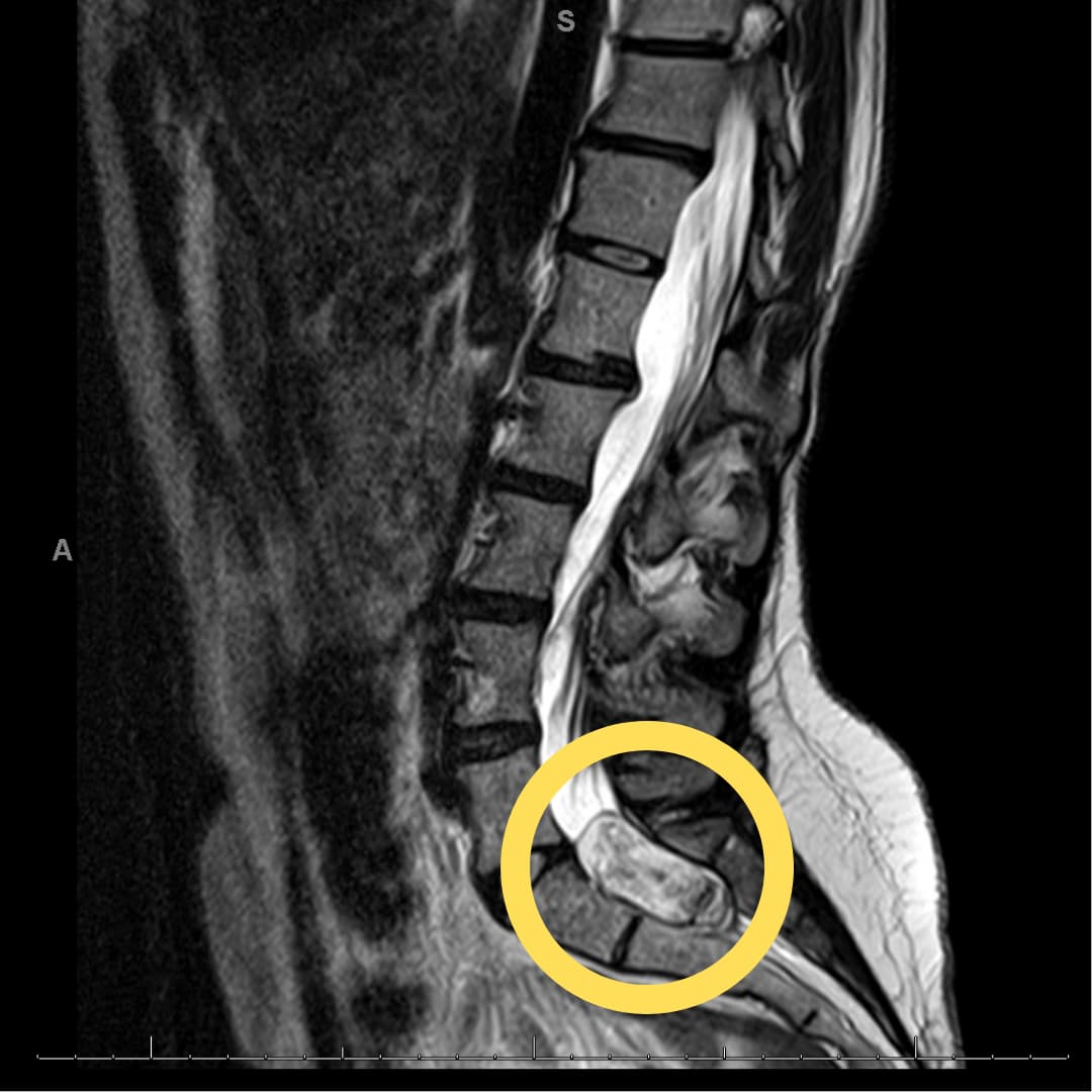 Scan of WHO Grade 1 Myxopapillary Ependymoma